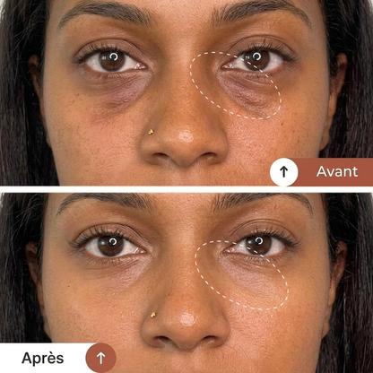 EyeLift® — Appareil Anti-Cernes EMS + Luminothérapie Rouge